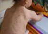Severe Chickenpox Outbreak Hits School Where Many Parents Refuse Vaccines Chickenpox