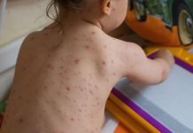 Severe Chickenpox Outbreak Hits School Where Many Parents Refuse Vaccines Chickenpox